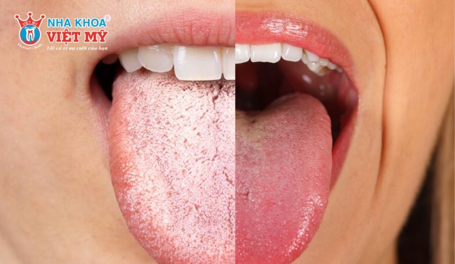 Bao lâu nên làm sạch lưỡi