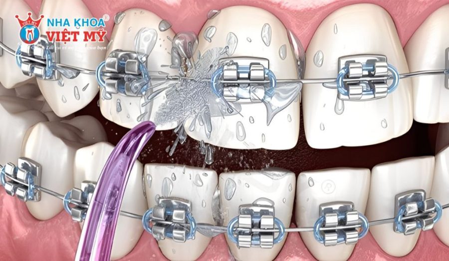 Người đang niềng răng có thể sử dụng máy tăm nước