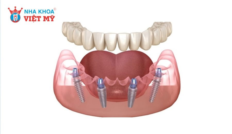 Cắm Implant All On 4 dùng 4 trụ Implant phục hình toàn hàm cố định