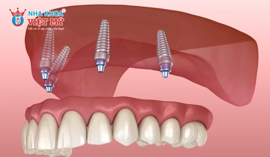 Cắm Implant All-on-4 dùng 4 trụ để phục hồi toàn hàm, tiết kiệm chi phí