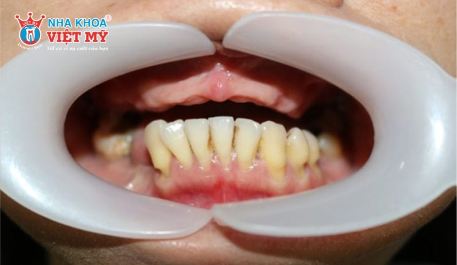 All On 4 là phù hợp cho khách hàng mất răng toàn hàm hoặc hàm trên hoặc hàm dưới