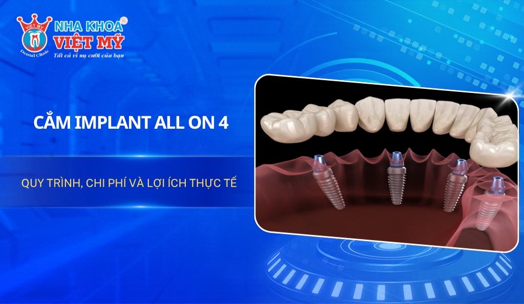 Cắm Implant All on 4: Quy trình, chi phí và lợi ích thực tế