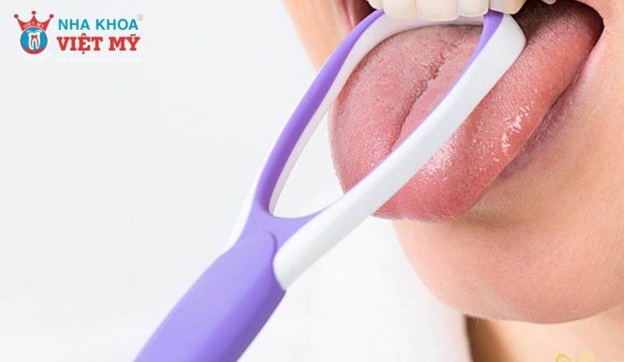 Cạo lưỡi là cách vệ sinh răng miệng sau khi niềng răng không thể thiếu