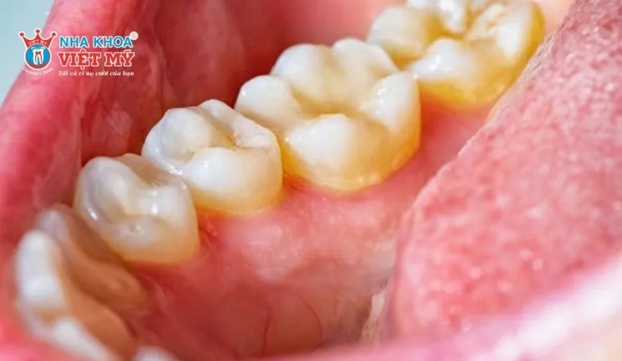 Cao răng là những mảng bám đã được vôi hóa