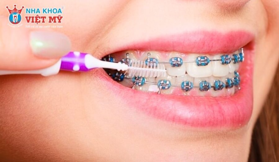 Chải răng đúng sẽ loại bỏ mảng bám dễ dàng