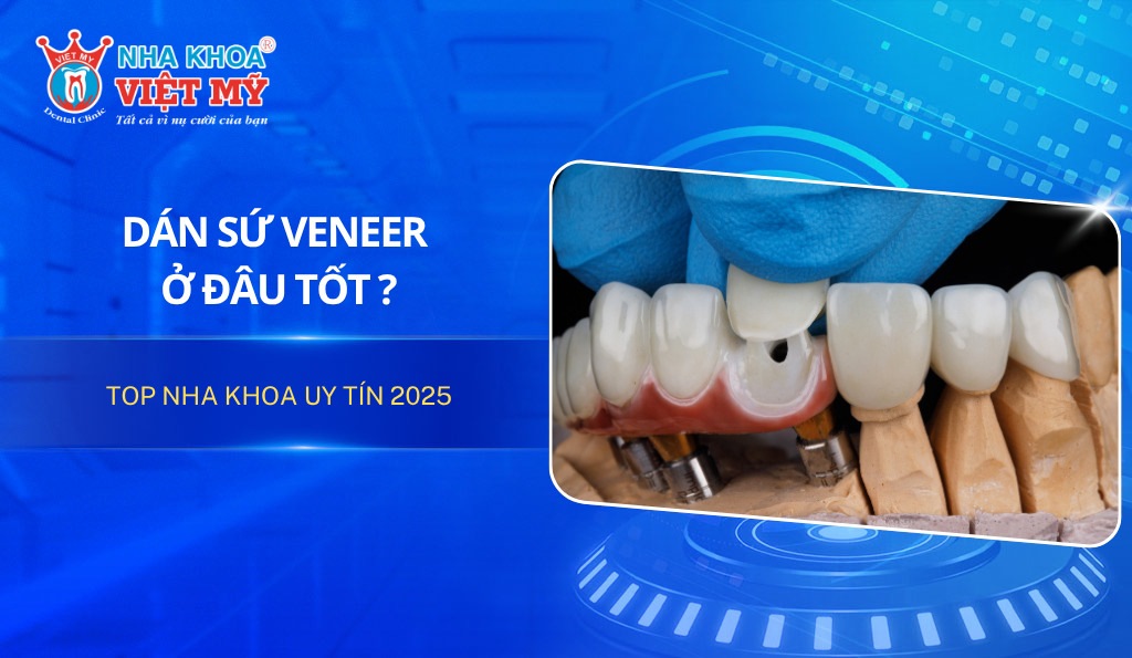 Dán răng sứ Veneer ở đâu tốt và top đơn vị uy tín