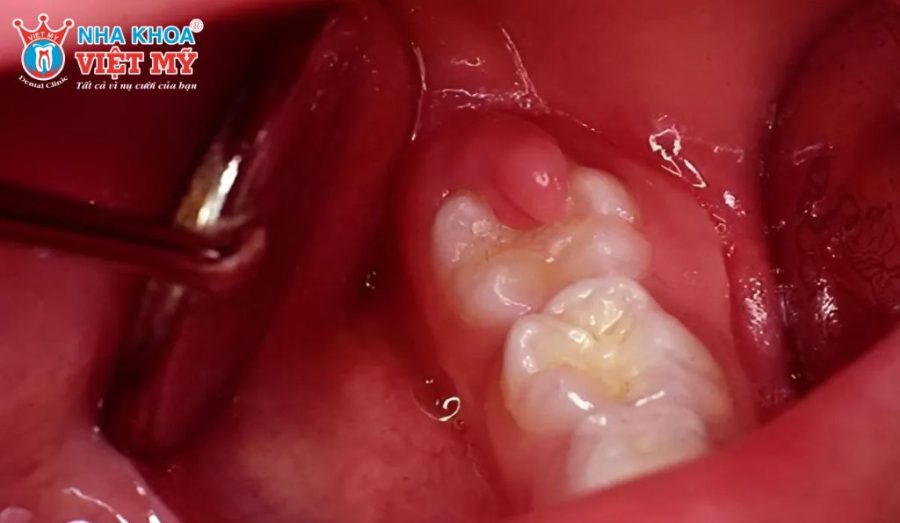 Dấu hiệu nhiễm trùng sau khi nhổ răng