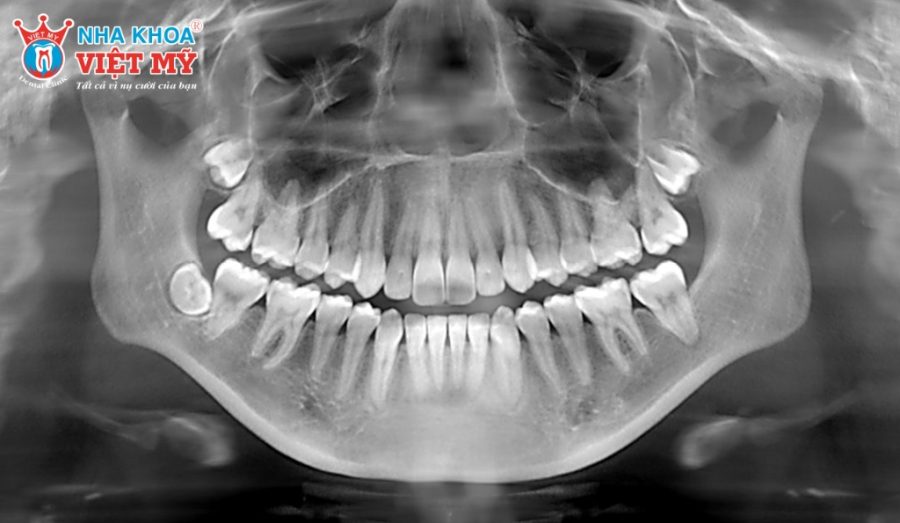 Làm sao để chẩn đoán nhiễm trùng sau khi nhổ răng
