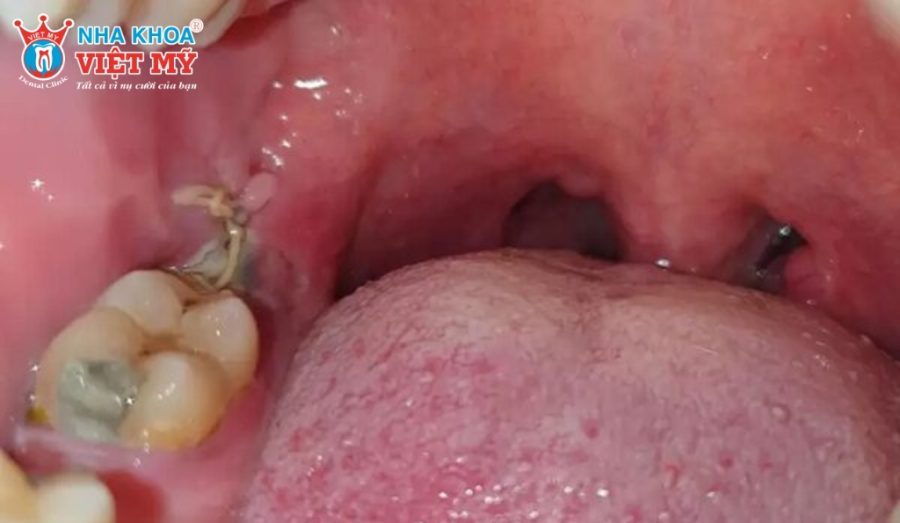 Nhiễm trùng sau khi nhổ răng có nguy hiểm không