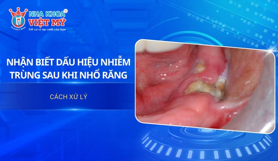 Nhận biết dấu hiệu nhiễm trùng sau khi nhổ răng và cách xử lý