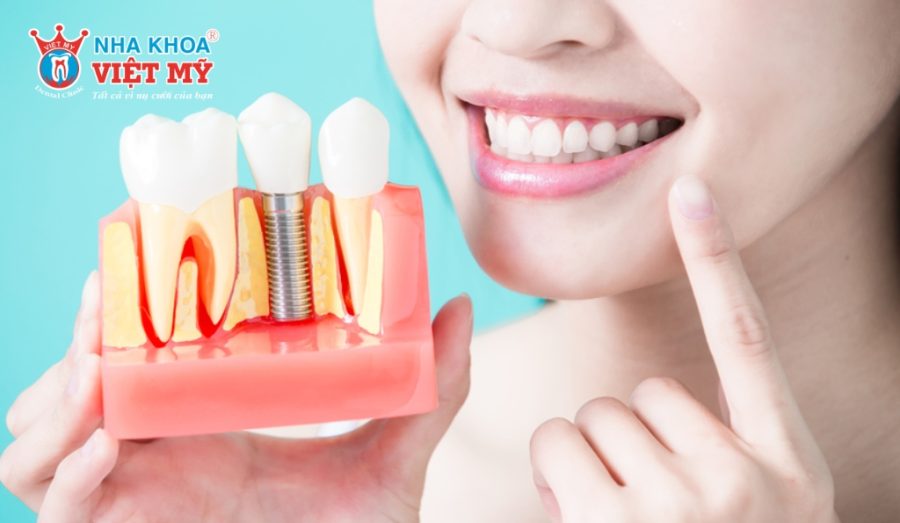 Dental Implants Aftercare - Tooth Structure Model