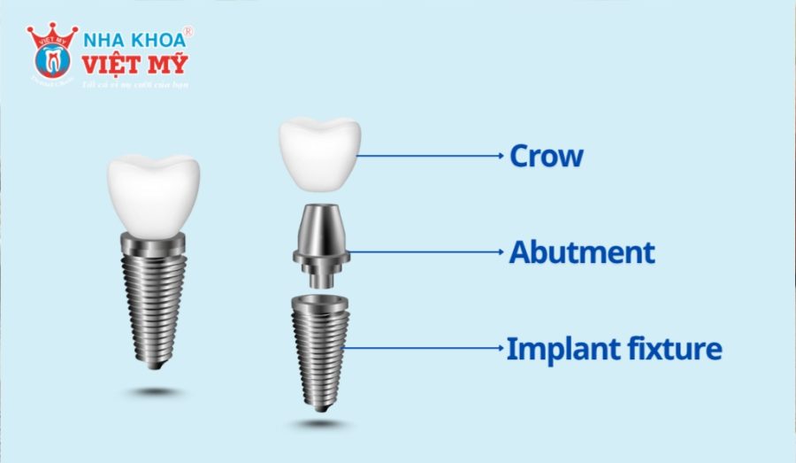 A dental implant consists of three components: implant fixture, abutment and crown