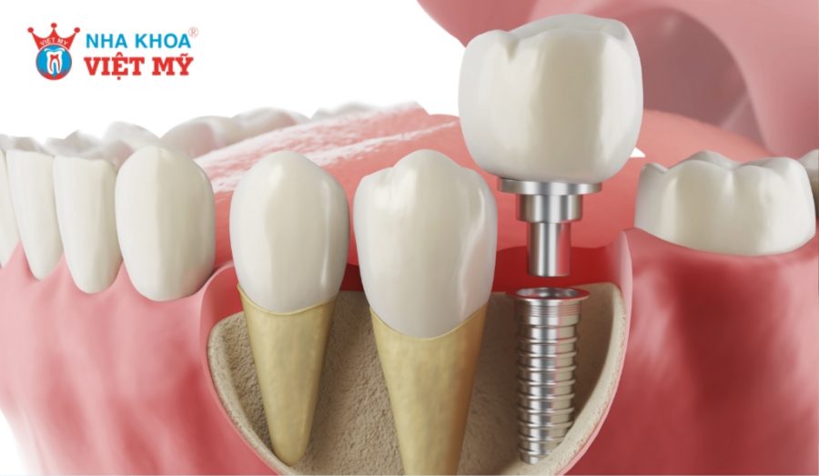 The bone integration process takes 3 - 6 months