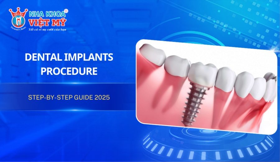Dental Implants procedure: Step-by-step guide 2025