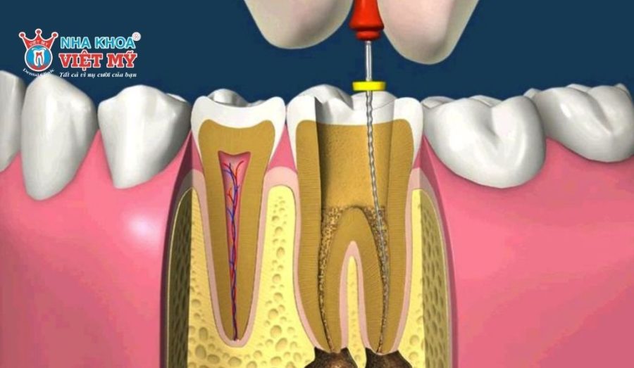 Giá điều trị lại tủy răng phụ thuộc vào nhiều yếu tố