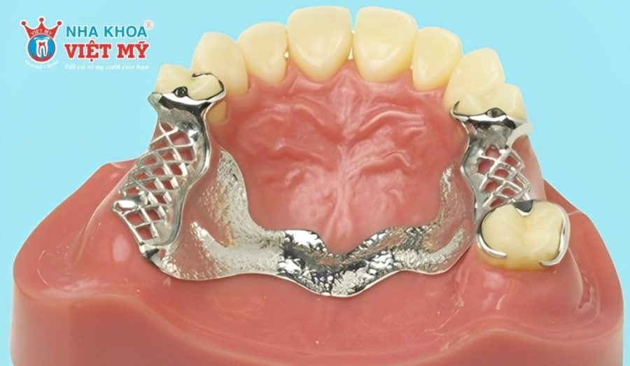 Hàm khung kim loại