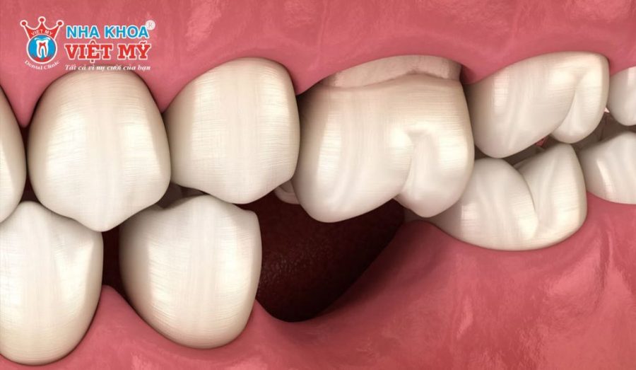 Hàm khung liên kết không ngăn chặn được tình trạng tiêu xương hàm