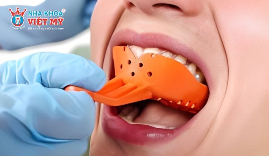 Bác sĩ tiến hành lấy dấu hàm bằng dụng cụ chuyên dụng