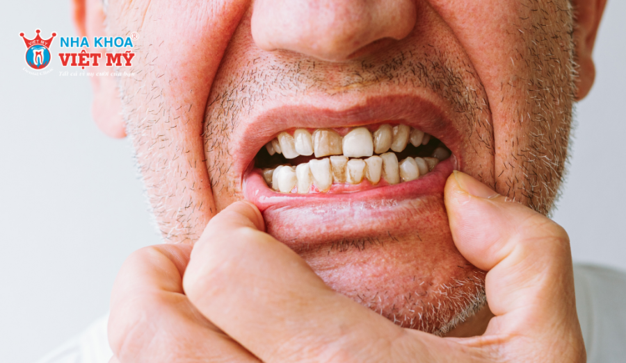 Hàm khung tháo lắp không phù hợp với người mắc bệnh nha chu