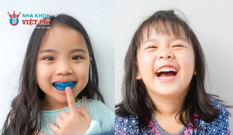 Niềng răng Trainer có hiệu quả với trẻ từ 5-10 tuổi