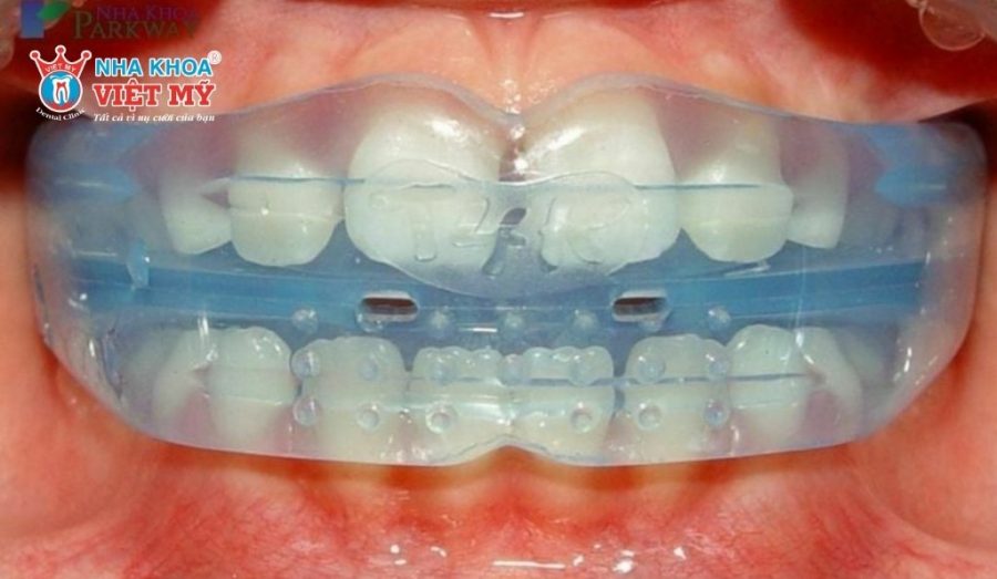 Đeo hàm Trainer đúng cách để tăng hiệu quả chỉnh nha