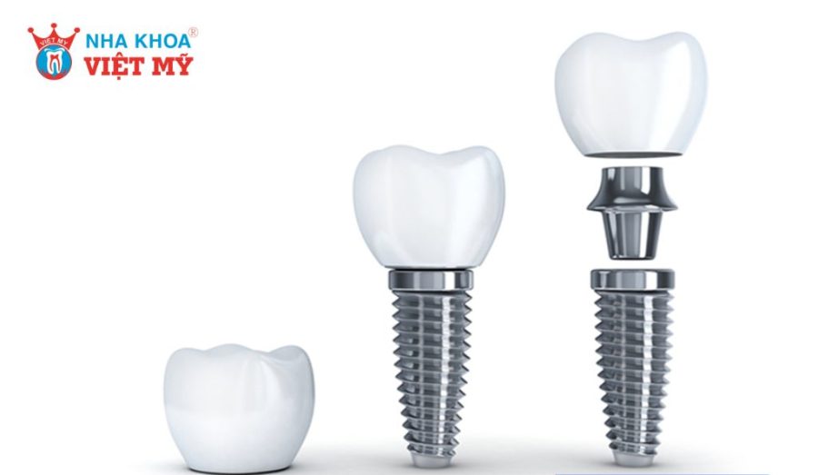Chi phí trồng Implant hiện nay là bao nhiêu?