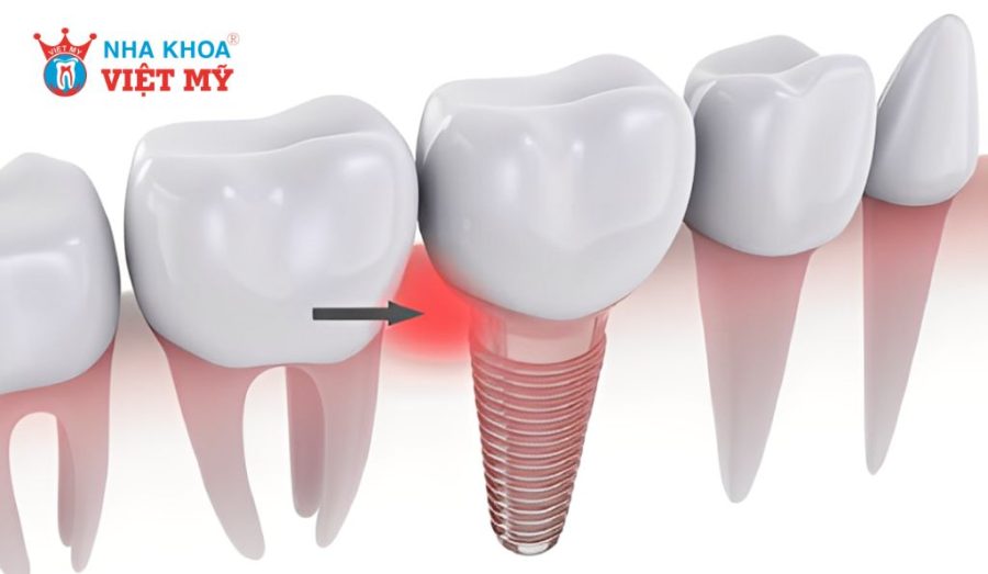 Vùng nướu quanh trụ Implant bị viêm, sưng đỏ