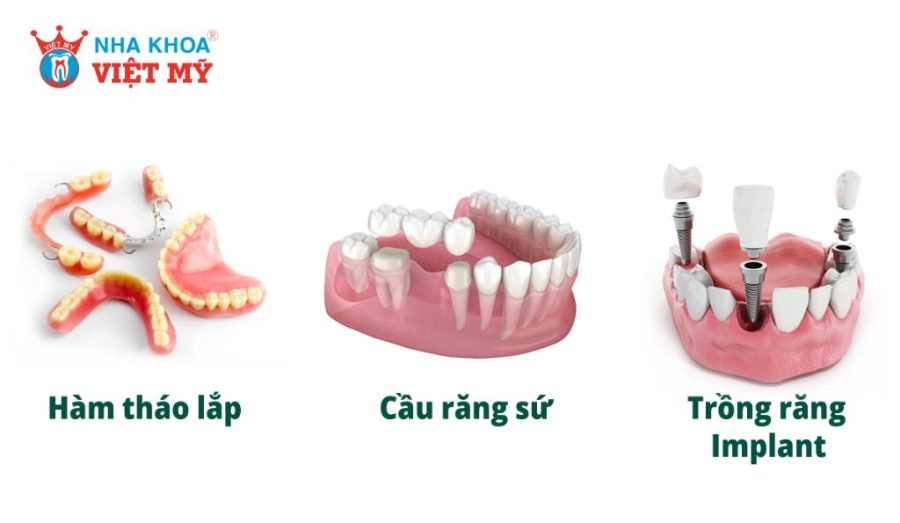 Cấy ghép Implant là phương pháp tối ưu hơn so với cầu răng sứ và hàm tháo lắp