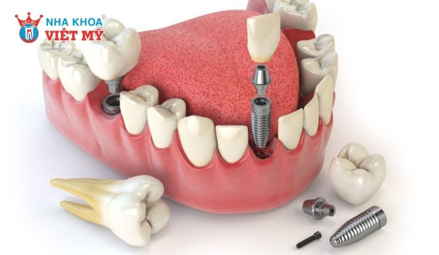 4 ảnh hưởng thường gặp khiến bạn cảm thấy hối hận khi trồng Implant quá trễ
