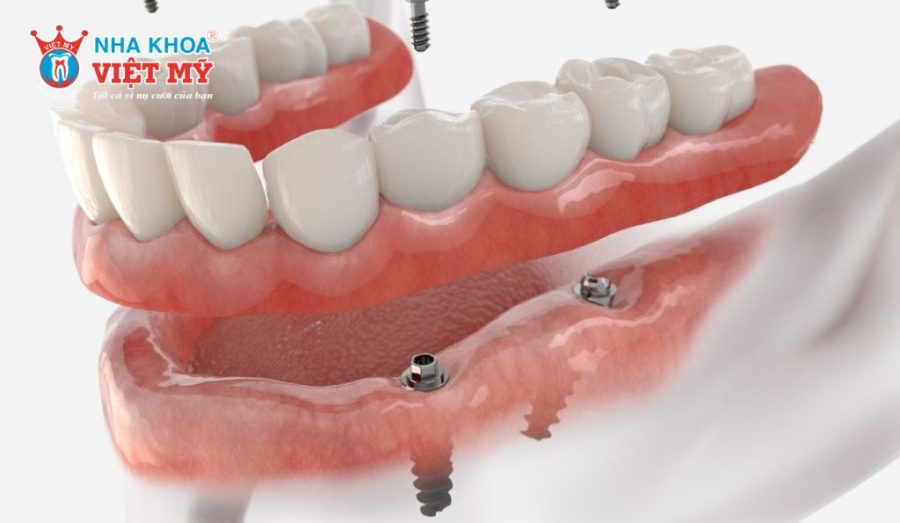 Quy trình cấy ghép Implant cần thực hiện chuẩn xác