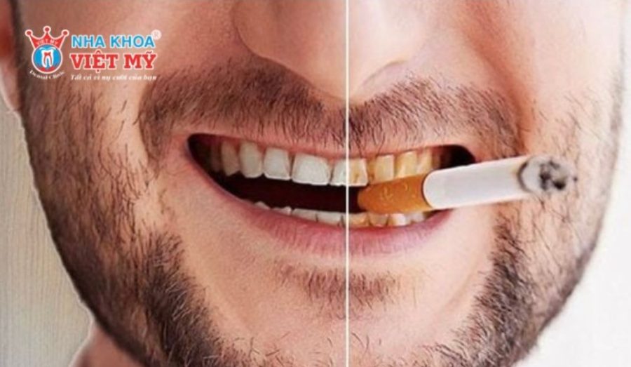Hút thuốc là nguyên nhân hàng đầu dẫn đến tình trạng đen răng ở kẽ