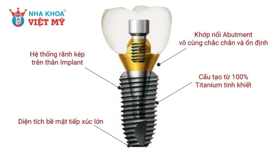 Cấu tạo và công nghệ nổi bật trụ Implant của Dentium Hàn Quốc