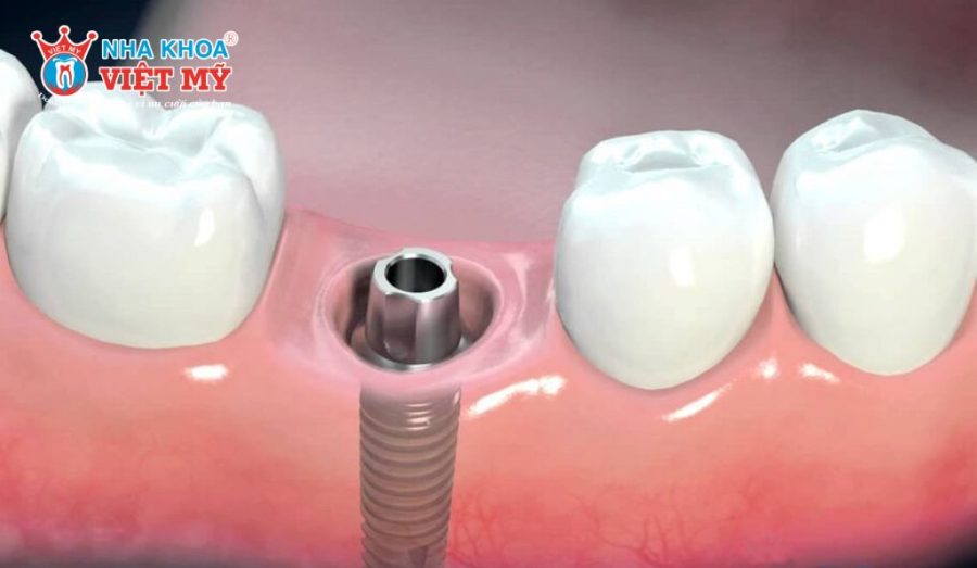 Quy trình cấy ghép trụ Dentium