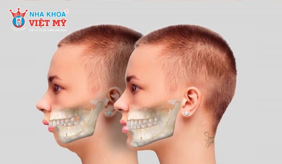 Phẫu thuật chỉnh hàm khắc phục trường hợp hô do xương hàm.