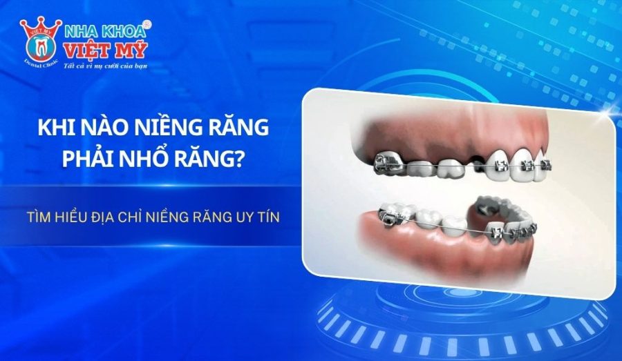 Khi nào niềng răng phải nhổ răng? Tìm hiểu địa chỉ niềng răng uy tín