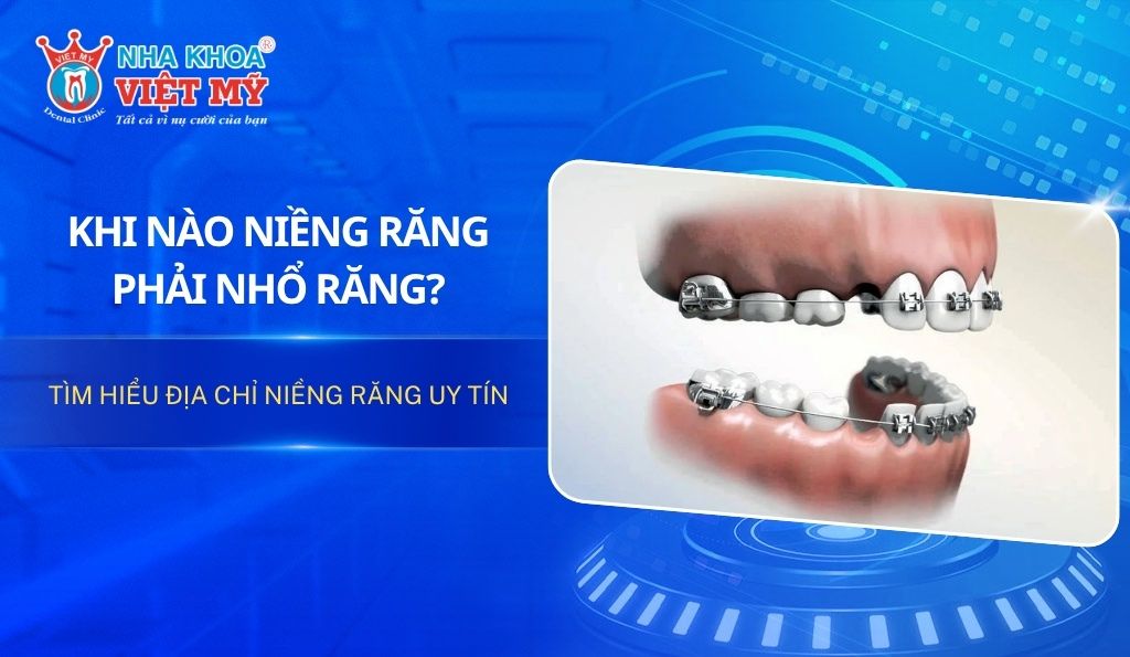 Khi nào niềng răng phải nhổ răng? Tìm hiểu địa chỉ niềng răng uy tín