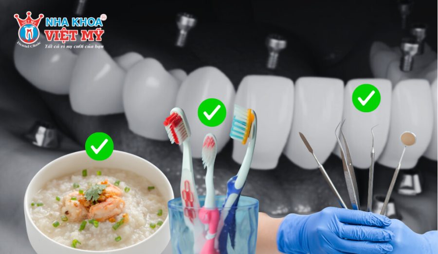 Hướng dẫn chăm sóc răng sau khi cắm implant