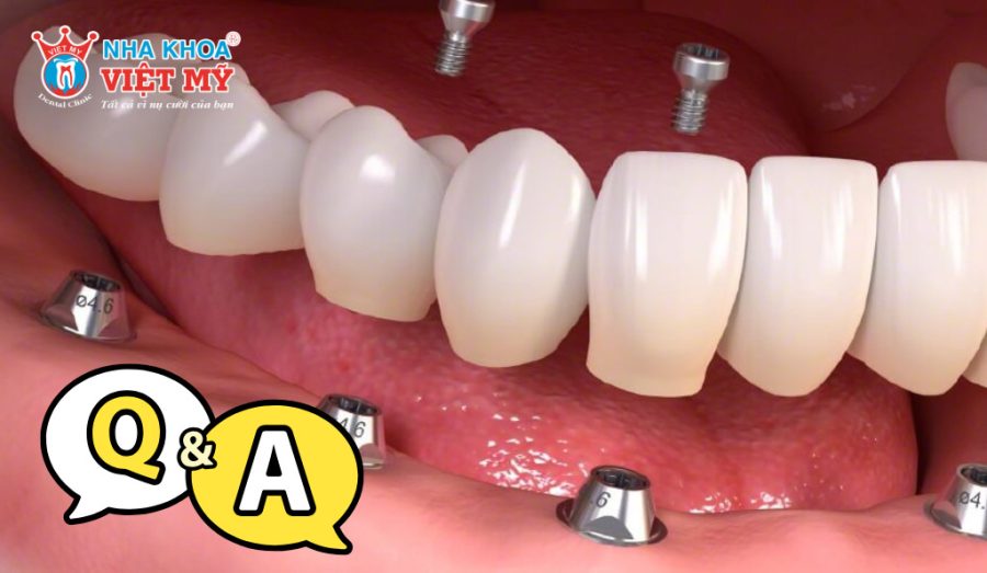 Câu hỏi thường gặp về vấn đề kiêng gì khi cắm răng Implant
