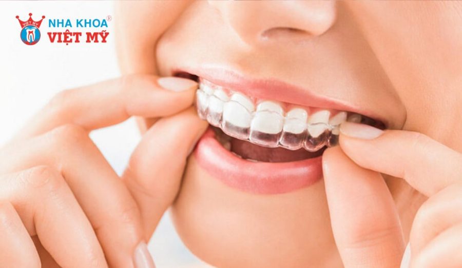 Cần đeo hàm duy trì ngay sau khi niềng xong để bảo đảm tình trạng răng
