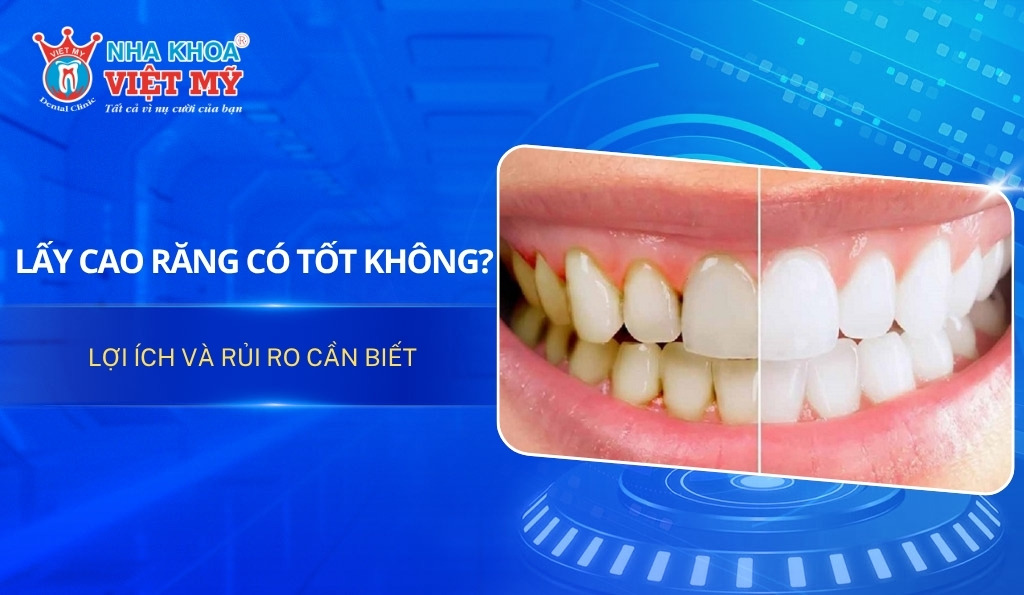Lấy cao răng có tốt không? Lợi ích và rủi ro cần biết