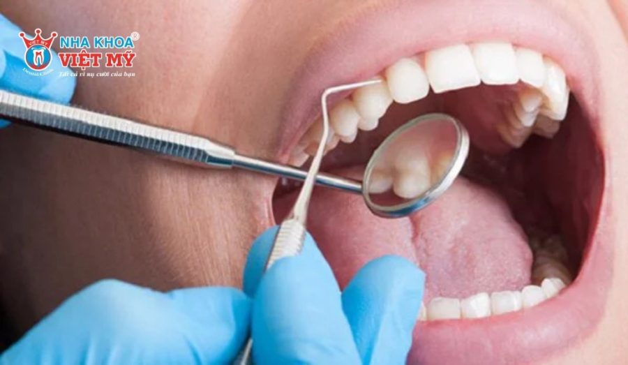 Lấy cao răng định kỳ 3-6 tháng/lần