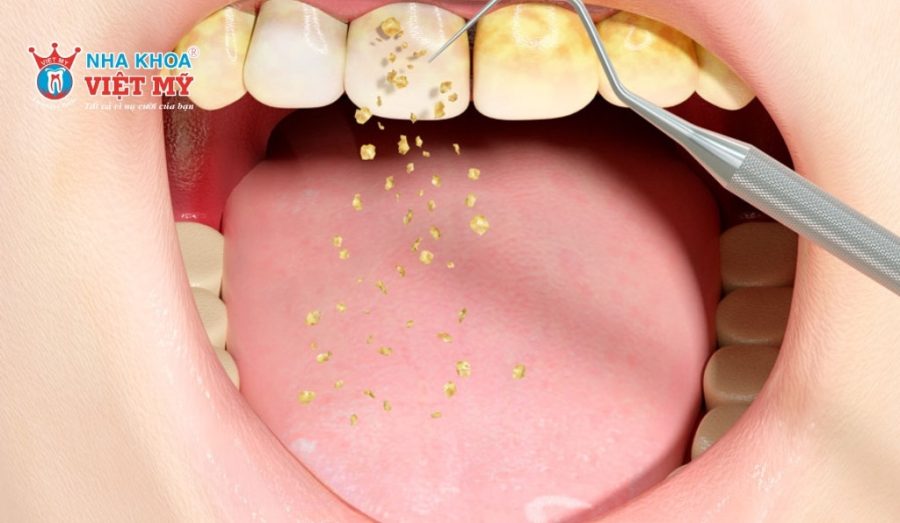 Lấy cao răng giúp bảo vệ sức khỏe răng miệng toàn diện