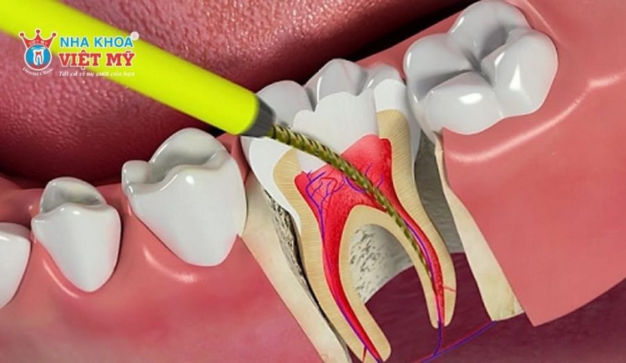 Lấy tủy răng nhằm loại bỏ tủy răng bị tổn thương, viêm nhiễm