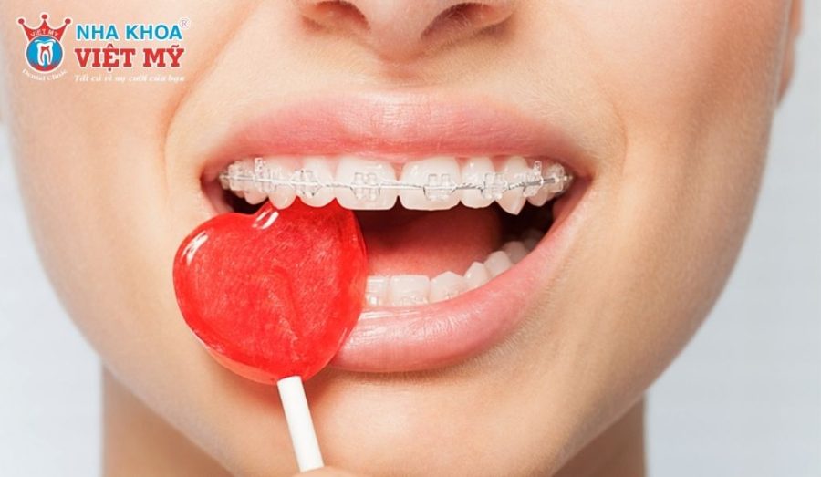 Lưu ý quan trọng về chế độ ăn uống khi niềng răng
