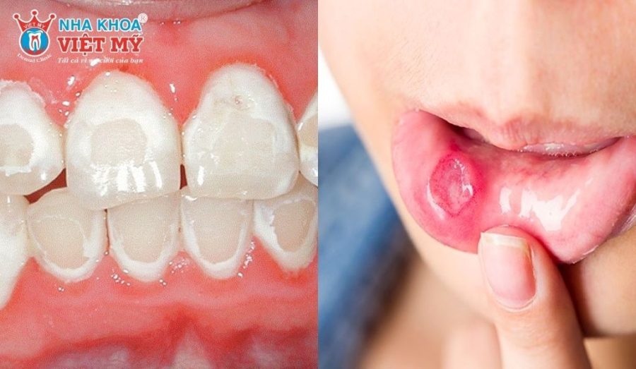 Mảng trắng hoặc vết loét lâu lành cho thấy dấu hiệu bệnh răng miệng nguy hiểm