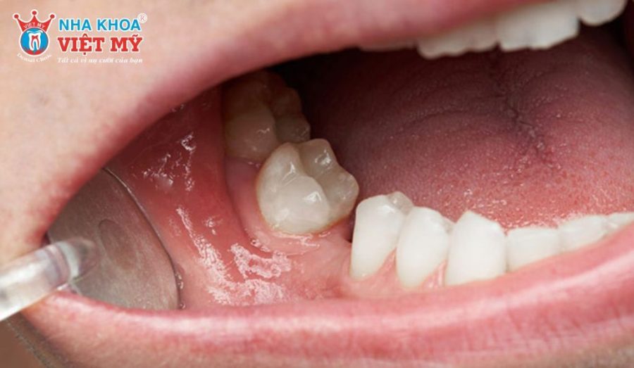 Mất răng cấm ảnh hưởng nghiêm trọng đến sức khỏe và thẩm mỹ