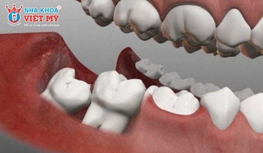 Mất răng cấm có thể gây tiêu hàm, thay đổi cấu trúc khuôn mặt