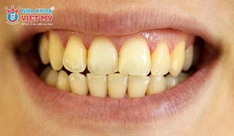 Men răng có thể hỏng từ nhiều nguyên nhân khác nhau