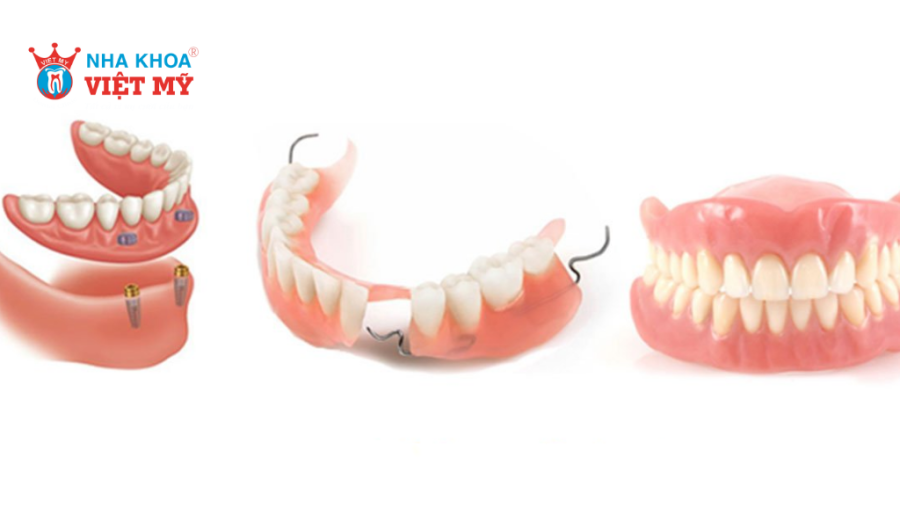 Mỗi loại hàm tháo lắp có mức giá khác nhau