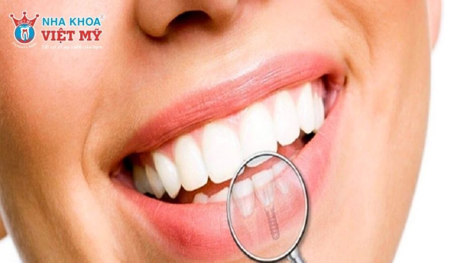 Mới tẩy trắng răng không nên ăn gì và kiêng bao lâu?